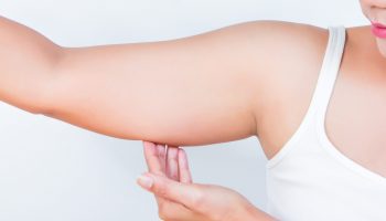 A cirurgia bariátrica traz diversos benefícios para a saúde e o bem-estar do paciente, recuperando, muitas vezes, a autoestima perdida devido ao excesso de peso e a doenças relacionadas. Mas um ponto que ainda deixa muitos pacientes em dúvida no pré e pós-cirúrgico é o excesso de pele depois do procedimento. Para ajudar você a compreender melhor essa questão, preparamos este artigo. Continue a leitura e descubra mais sobre esse tema importante. Excesso de pele depois da cirurgia bariátrica: o que você precisa saber A cirurgia bariátrica é um dos métodos mais eficazes para perda de peso. No entanto, ela só pode ser realizada por pacientes que se enquadram nos requisitos estabelecidos, como IMC elevado, doenças associadas e tentativas anteriores de outros tratamentos sem o sucesso esperado. Assim, ao realizar a cirurgia, espera-se uma elevada perda de peso, além da redução das dimensões da cavidade gástrica. Acontece que, com a perda de tecido adiposo - um tipo especial de tecido conjuntivo que se caracteriza por armazenar gordura em células especializadas, denominadas adipócitos - a pele perde sua elasticidade e acaba “despencando”, prejudicando não só a estética, como também podendo causar situações incômodas como problema postural e de equilíbrio, dermatites, falta de apetite sexual, entre outras. Nesse caso, a cirurgia plástica se apresenta como uma aliada na devolução da qualidade de vida aos pacientes e na recuperação de sua autoestima. Dicas do que fazer para diminuir o excesso de pele depois da cirurgia bariátrica A equipe transdisciplinar responsável pelo paciente irá fornecer uma série de orientações importantes para se lidar com essa e outras questões no período pós-cirúrgico. Entre as práticas recomendadas, podem estar: a primeira grande dica é continuar o acompanhamento com a equipe transdisciplinar. Ninguém melhor do que a sua equipe médica para instruí-lo quanto aos melhores procedimentos tendo seu histórico e suas necessidades; específicas em consideração. a mudança de hábitos envolve, principalmente, dieta balanceada e prática de exercícios físicos. Tomar essas duas atitudes irá ajudar a transformar sua mente e seu corpo; fazer massagem linfática em áreas consideradas mais críticas, como pernas e abdômen, ajuda a ativar a circulação e reduzir a flacidez; cremes hidratantes e óleos especiais ajudam a manter a pele hidratada e favorece sua firmeza; as cirurgias plásticas mais procuradas são abdômen, mamas, braços, coxas e face, nessa respectiva ordem. Nesse procedimento, a gordura é removida e os músculos abdominais são expostos e saturados, com o intuito de ficarem mais firmes, melhorando assim o contorno da região trabalhada. Além disso, a cirurgia plástica é capaz de eliminar a separação dos músculos da região do abdômen. Sendo assim, a pele é esticada e todo o excesso é removido. Por fim, é importante ter em mente que a cirurgia bariátrica é um procedimento médico e não estético. Por isso, por vezes, pode ser necessário realizar alguns cuidados extras ou outros procedimentos cirúrgicos para corrigir visualmente o que incomoda o paciente. Para compreender melhor como é, os benefícios e os cuidados demandados por esse procedimento, baixe nosso Guia prático para quem precisa fazer uma cirurgia bariátrica.