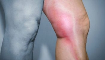 Obesidade e Trombose