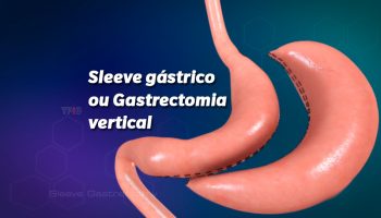Sleeve Gástrico: O que é e para quem é indicado